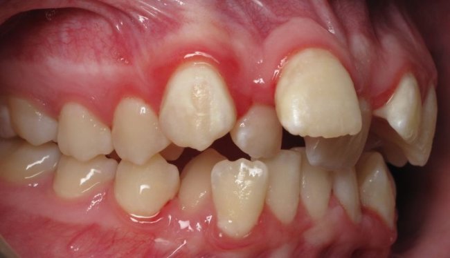 牙齿矫正为什么常常需要拔牙？