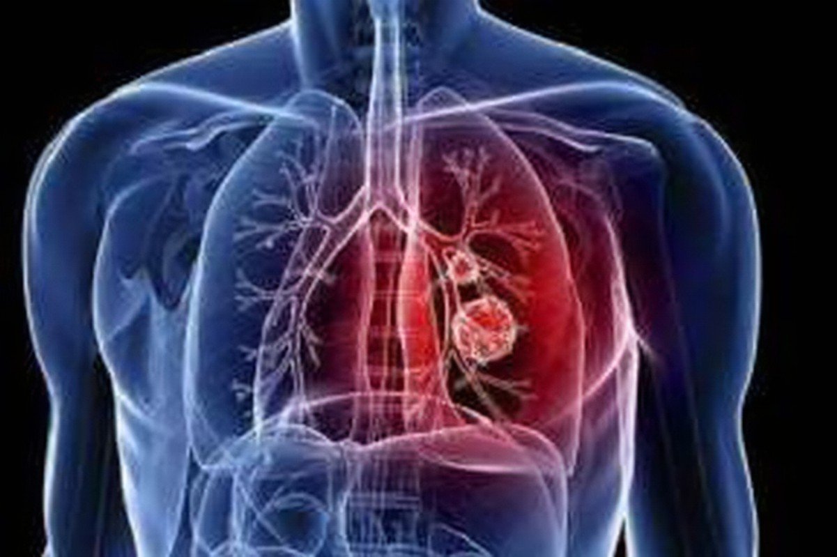 感染新型冠状病毒的初期表现有哪些症状？