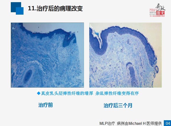 激光怎样去除痘坑的
