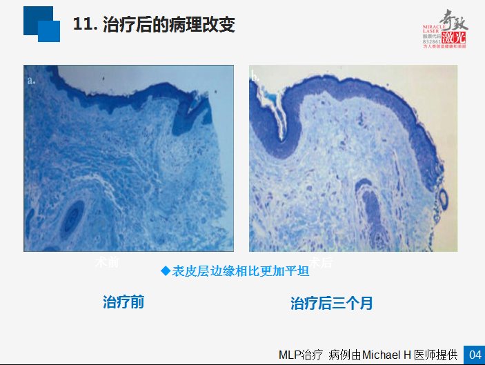 激光怎样去除痘坑的