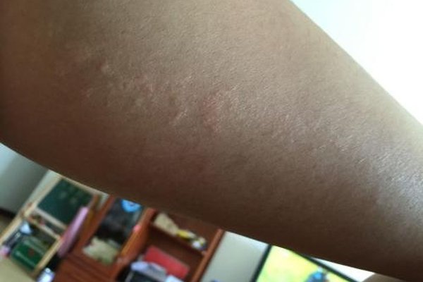 疱疹的症状图片表现是什么