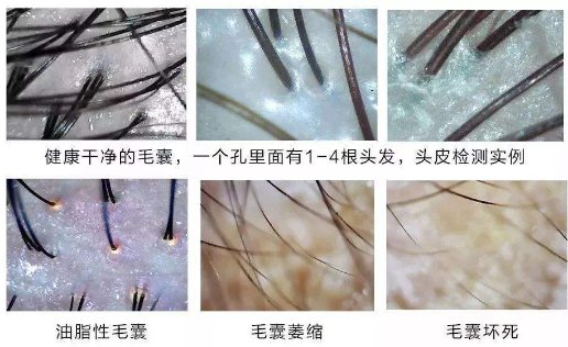 脂溢性脱发做个毛囊检测多少钱