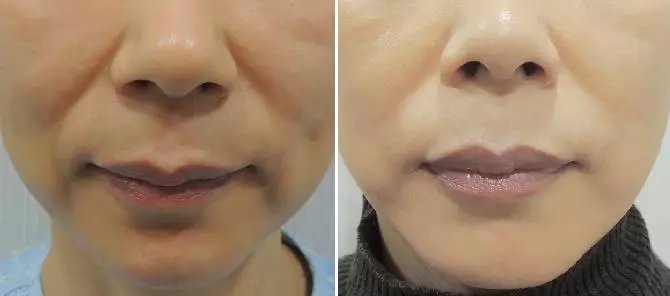 脸部线雕副作用