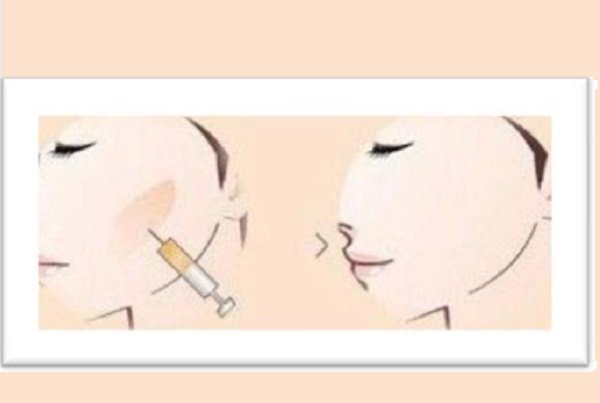 脂肪胶填充脸部能保持多久呢？