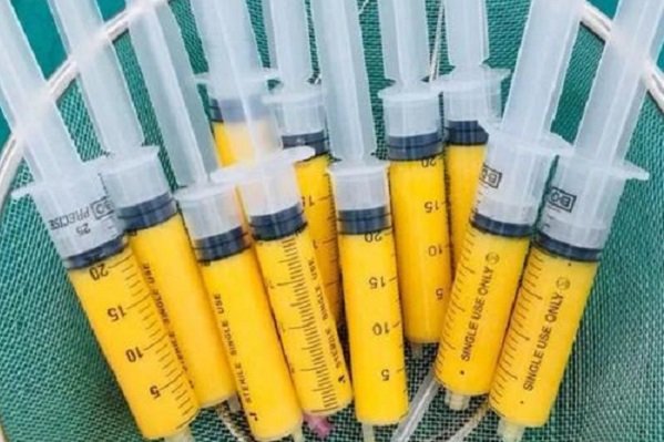 脂肪胶填充脸部能保持多久呢？