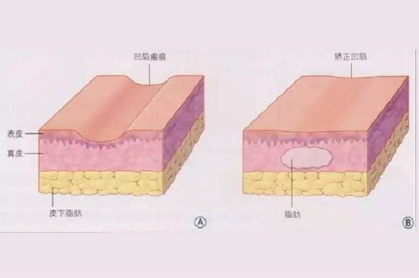 脂肪胶填充脸部能保持多久呢？