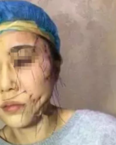 脸部线雕副作用