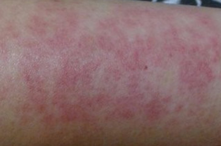 怎么查甲醛过敏