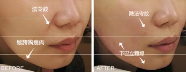 脸部线雕副作用