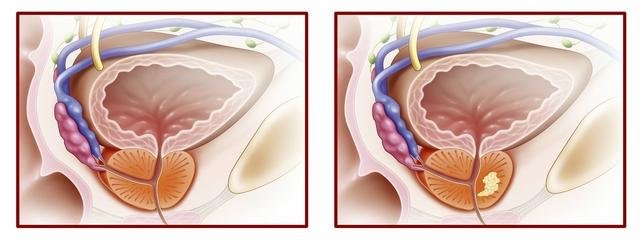 57岁男子在三亚医院做前列腺电切术后死亡，医院对此有何回应？