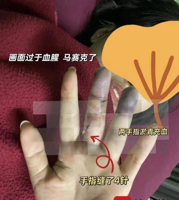 女子巴厘岛打卡“恶魔的眼泪”险丧命：手上腿上多处受伤