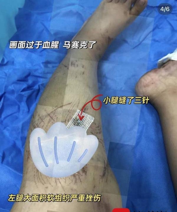 女子巴厘岛打卡“恶魔的眼泪”险丧命：手上腿上多处受伤