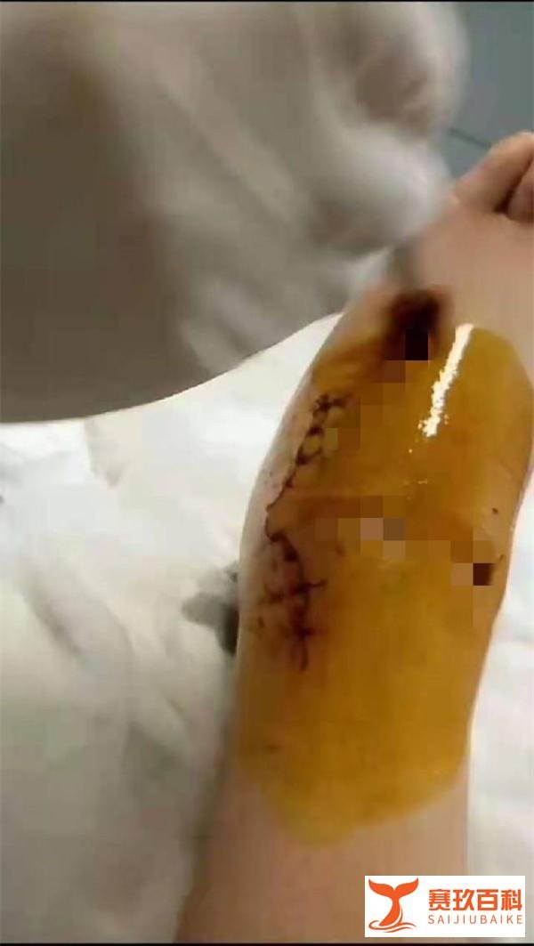 泸州14岁女生被罚150个下蹲致残 调解协议达成：学校一次性补偿39万元