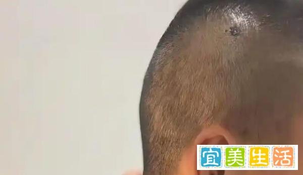 华人职业拳击手在澳大利亚遇袭，后脑被改锥类锐器刺伤昏迷险丧命
