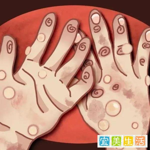 出现女性猴痘感染者意味着什么？