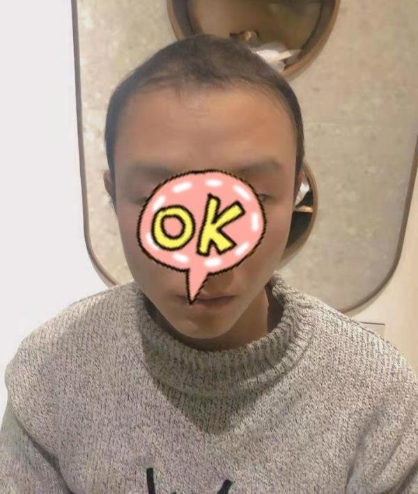 第一批00后开始脱发了,你的发际线没事吧?
