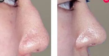 驼峰鼻矫正需要多少钱