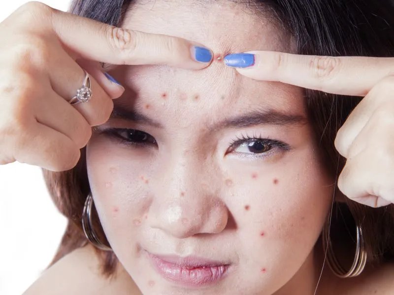 该怎么去痘印最有效