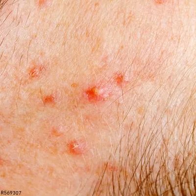 治疗疱疹的药膏有哪些 这几种药可应对疱疹