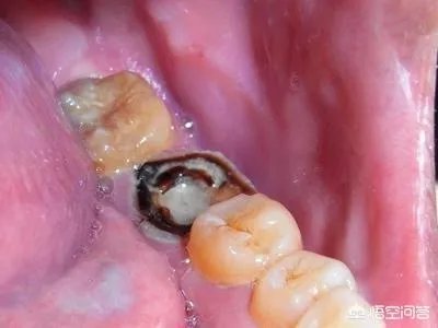 被虫蛀的牙只能拔掉吗