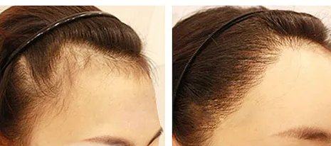 无痕植发哪家好