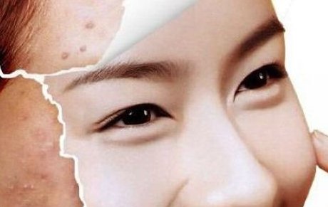 像素激光祛痘坑效果怎么样