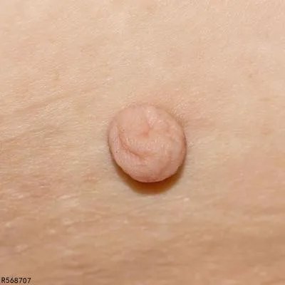 传染性软疣长什么样子 三个症状揭开传染性软疣面纱