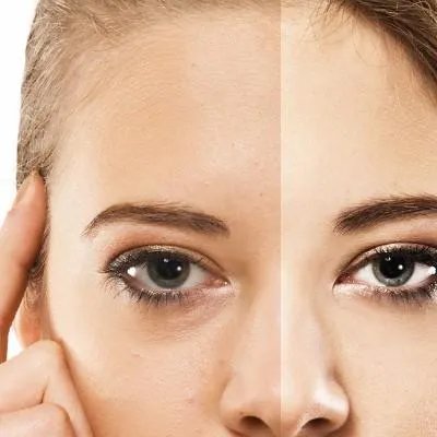 眼袋下垂怎么办