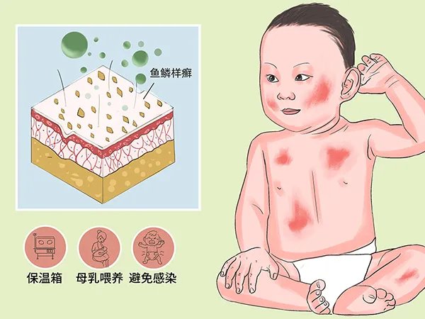 火棉胶婴儿是什么意思？（一种罕见的遗传性鱼鳞病）