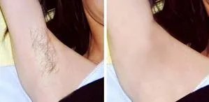 冰点脱毛价格要多少钱