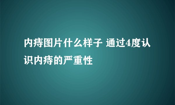 内痔图片什么样子 通过4度认识内痔的严重性