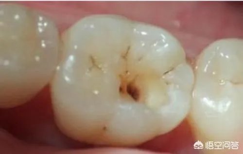 被虫蛀的牙只能拔掉吗