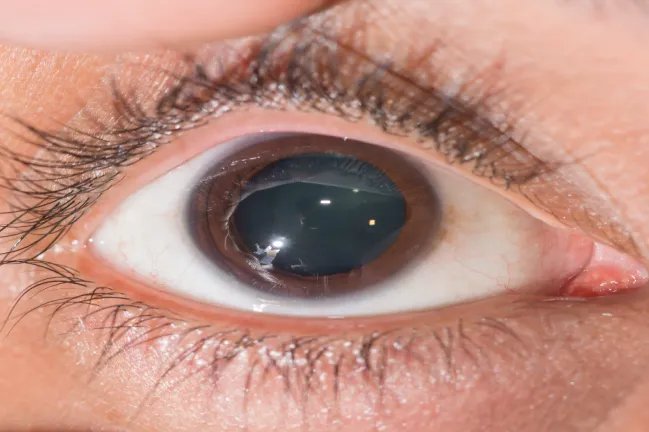 瞳孔放大是什么样子的