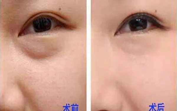 眼袋去除手术多少钱