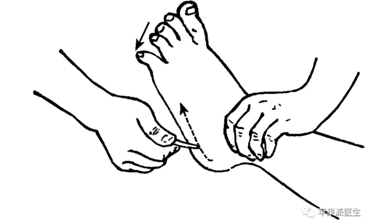 理解Babinski征,划对Babinski征