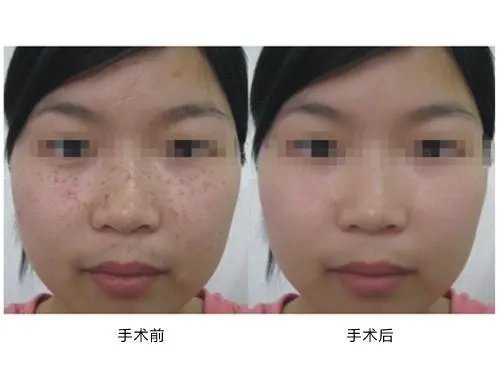 祛斑的价格是多少呢