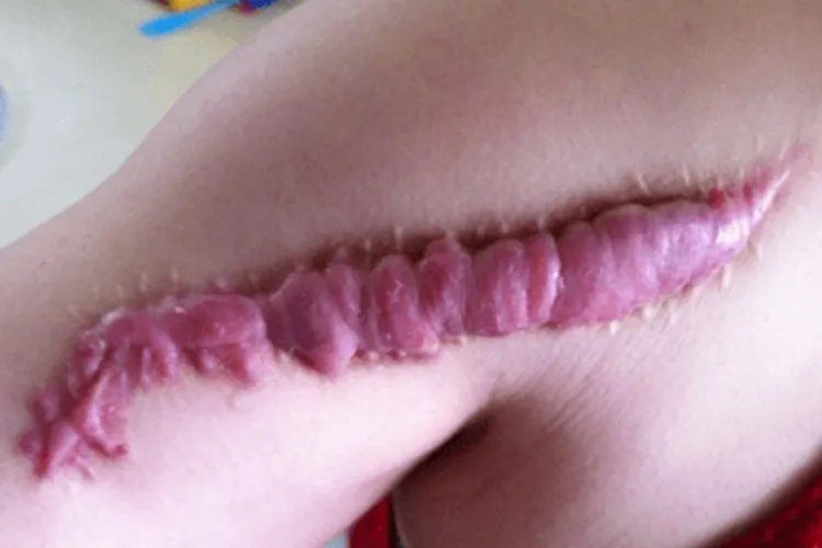 疤痕性皮肤图片