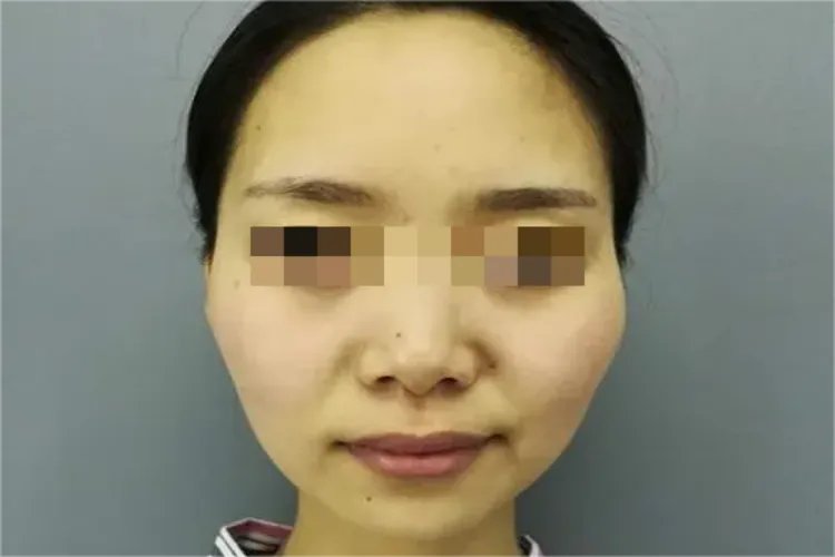 额头两侧凹陷图片