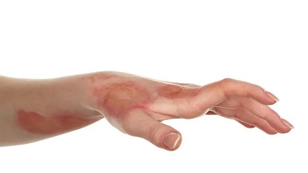 烧伤整形是怎么回事