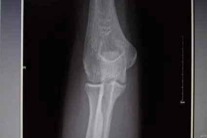 鹰嘴骨正常图片