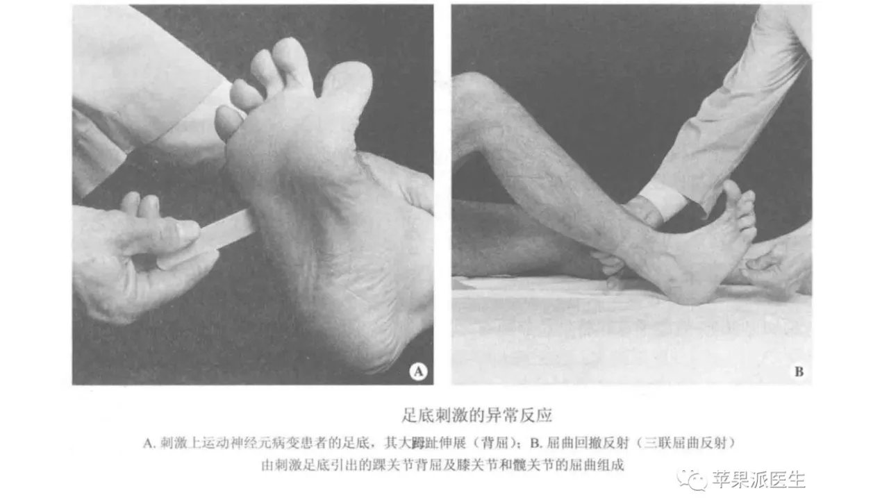 理解Babinski征,划对Babinski征