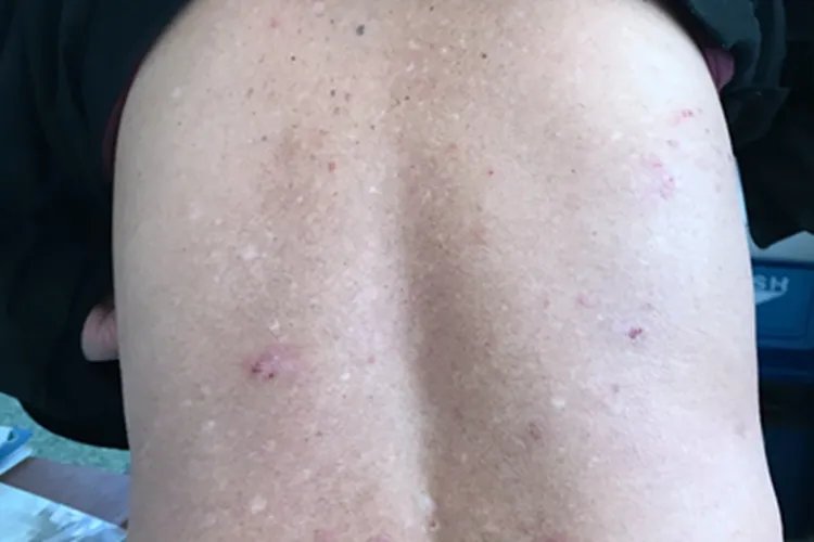 慢性湿疹红点图片