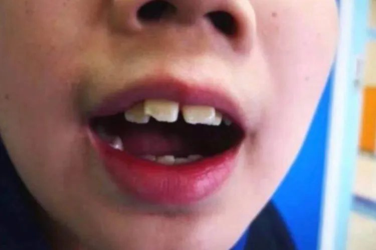 13岁娃腺样体肥大面容照片