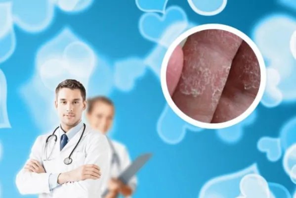 牛皮癣用什么药最有效