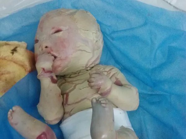 火棉胶婴儿是什么意思？（一种罕见的遗传性鱼鳞病）