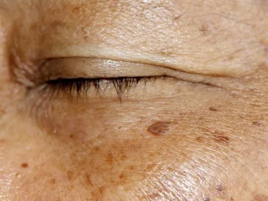 怎么样去黄褐斑