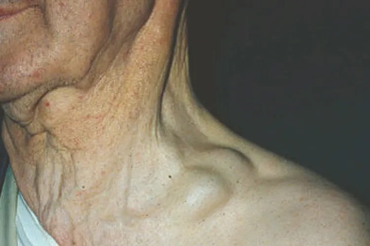 淋巴癌的早期症状图