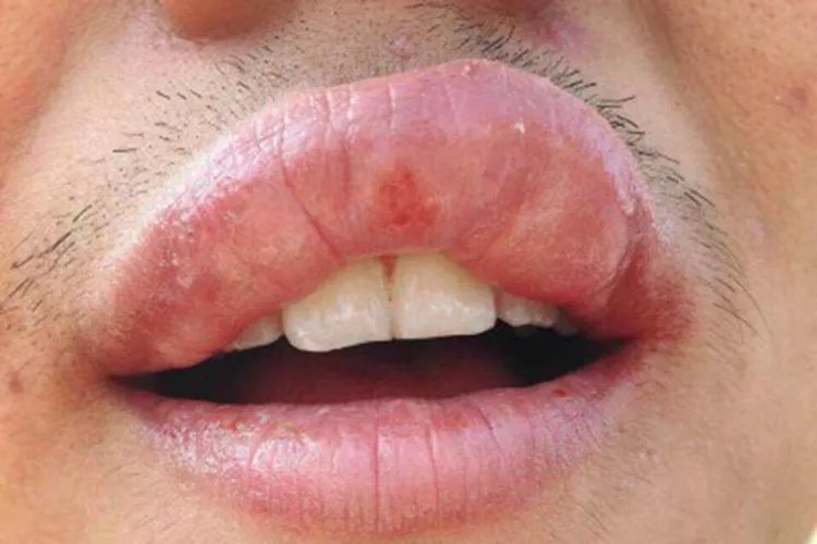 海鲜过敏症状图片