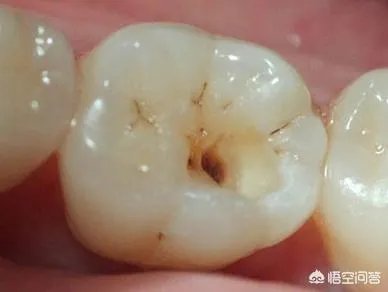 被虫蛀的牙只能拔掉吗