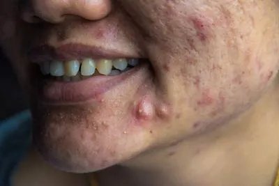 痤疮不可以吃什么食物